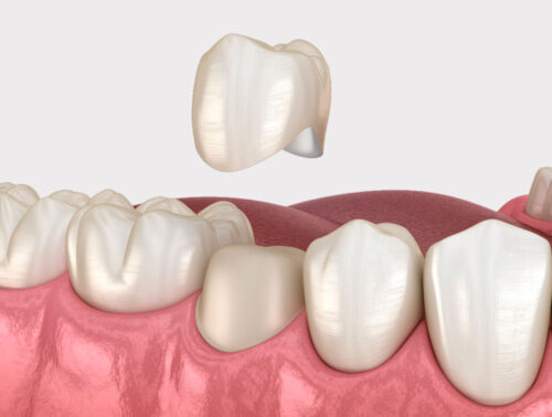 keramicheskaya-koronka